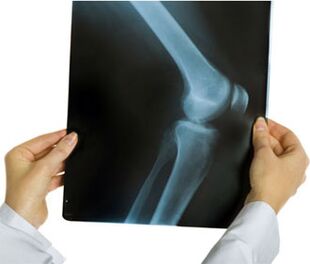 Ceļa locītavas artrozes rentgena starojums